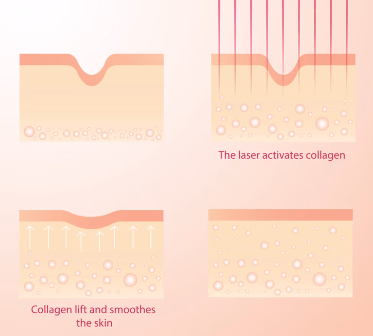 Diagram showing controlled laser dermal heating and collagen support