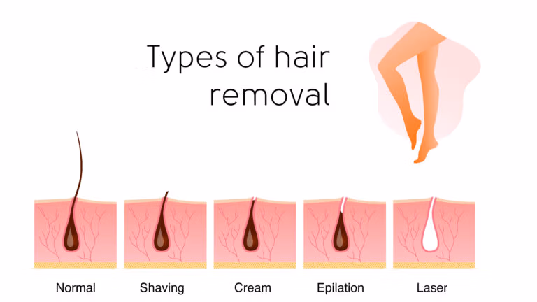Infographic comparing shaving, cream, epilation, and laser hair removal at the follicle