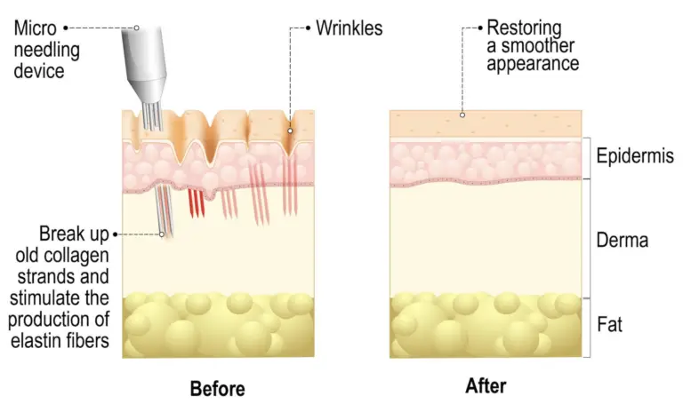 Microneedling diagram showing microchannels and collagen support