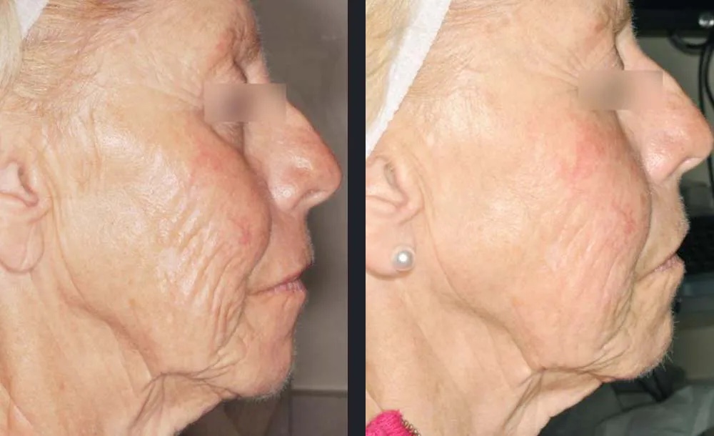 Laser Skin Tightening before and after example
