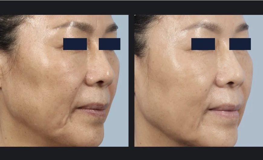 Laser Skin Tightening before and after example showing the face
