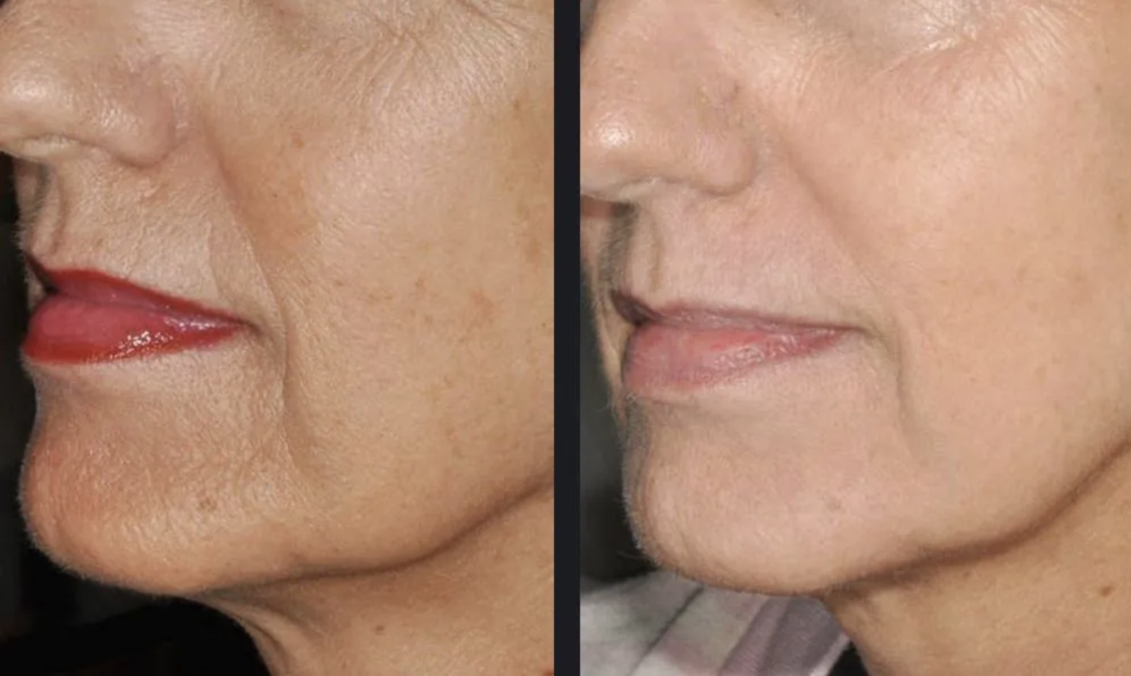 Laser Skin Tightening before and after example showing the lower face