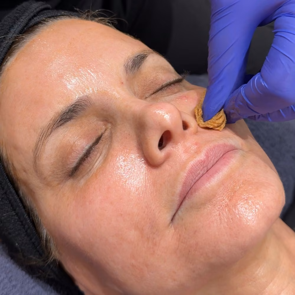 VI Peel treatment at Corinne Aesthetics