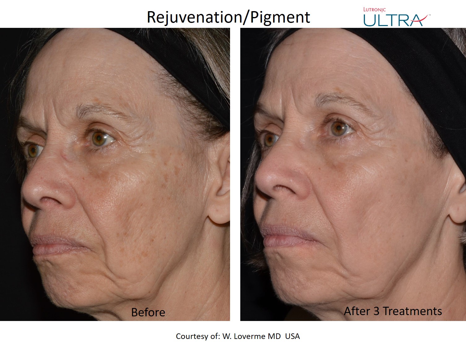 Ultra rejuvenation and pigment before and after example after 3 treatments