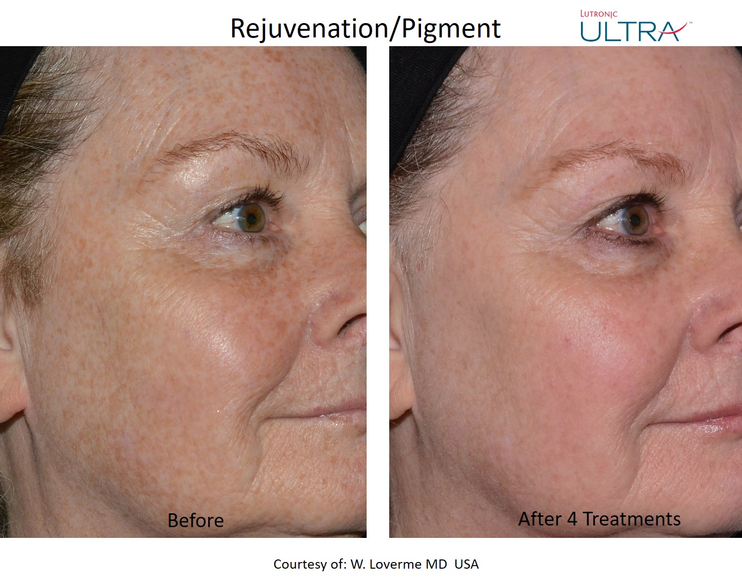 Ultra rejuvenation and pigment before and after example after 4 treatments
