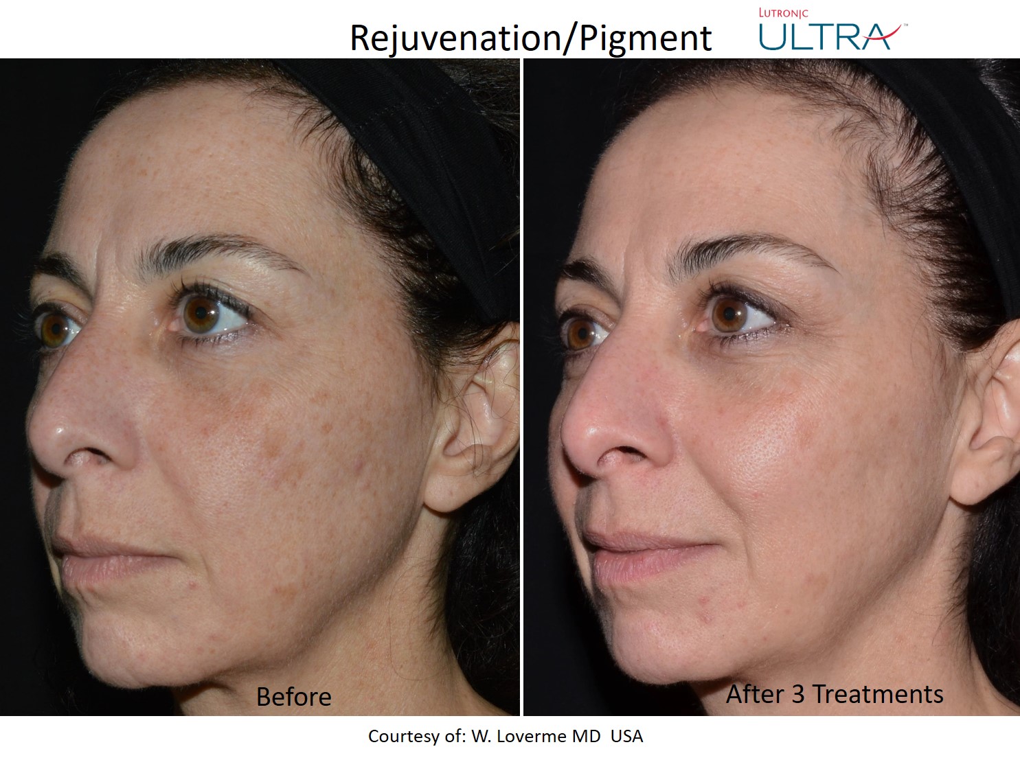 Ultra rejuvenation and pigment left-side before and after example after 3 treatments