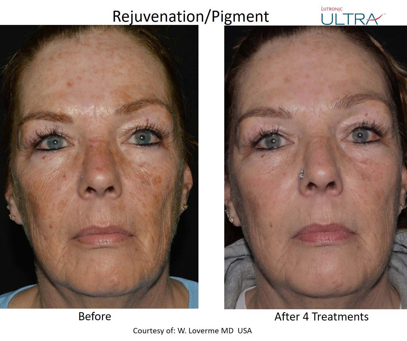 Ultra rejuvenation and pigment frontal before and after example after 4 treatments