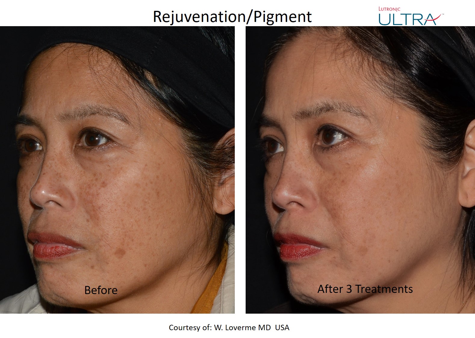 Ultra rejuvenation and pigment left-side before and after example after 3 treatments