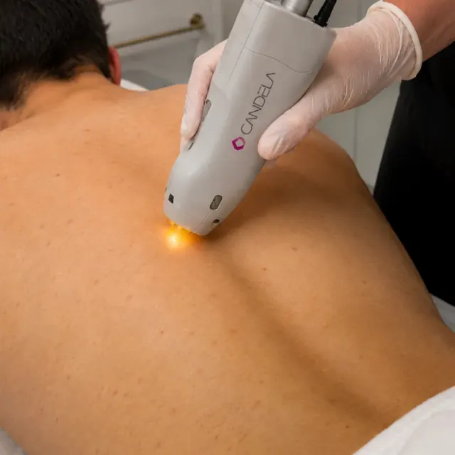Laser hair removal area illustration for full back